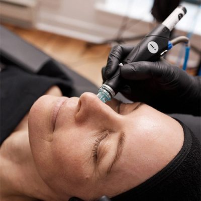 Customized Peel
