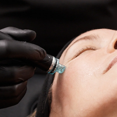 Microdermabrasion Hydrafacial